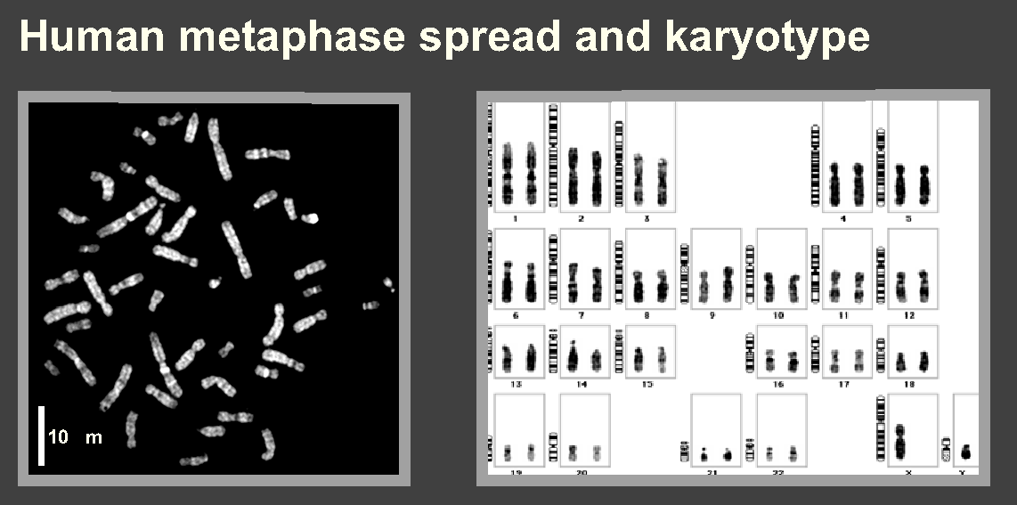 karyotype male. + 1 Y in male). Karyotype